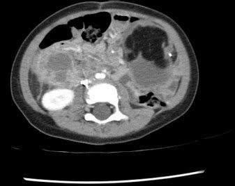 Abdominal CT scan with intravenous contrast showing a well marginated,... | Download Scientific ...