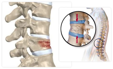 Fractura Vertebral Neuroqx Canarias