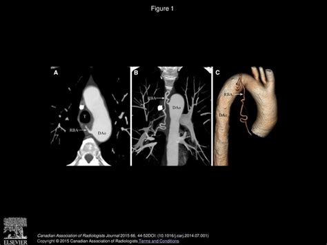 The Normal Anatomy And Variations Of The Bronchial Arteries Evaluation