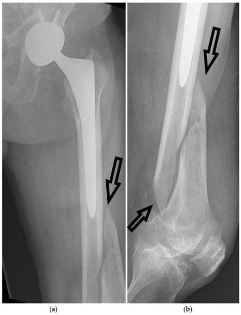 Anatomia Free Full Text Radiological Diagnosis And Imaging Of Femoral Shaft Fractures