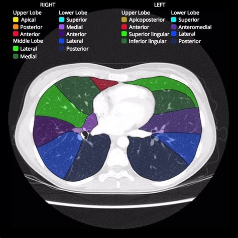 Bronchopulmonary segments: annotated CT | Radiology Case | Radiopaedia ...