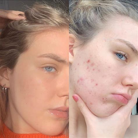 Accutane Before And After 9 Women On Their Isotretinoin Side Effects