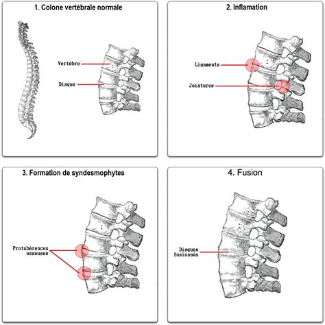 Spondylarthrite ankylosante Définition et Explications