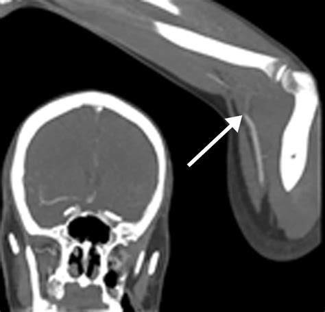 Multisystem Imaging Manifestations Of Covid Part Viral