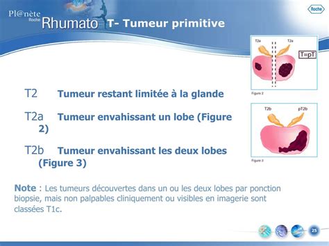 Ppt Classification Tnm Illustrée Powerpoint Presentation Free