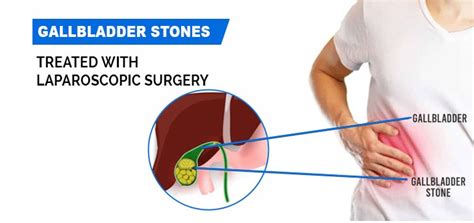 Laparoscopic Gallbladder Surgery In Amritsar Altec Hospital