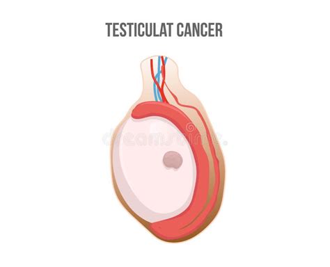 Testicular Cancer Stock Vector Illustration Of Cells 32882204