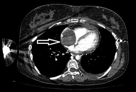 Preoperative Computed Tomography Angiography Image Of The Mass That Download Scientific Diagram