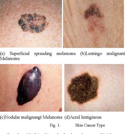 Superficial Spreading Melanoma Vs Lentigo Maligna