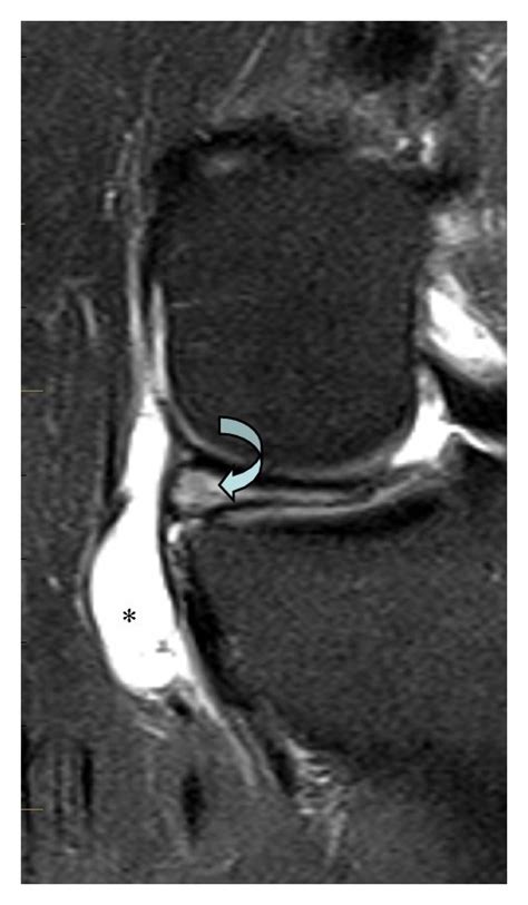 Mri And Ultrasound Demonstrate The Meniscal Cyst A Coronal