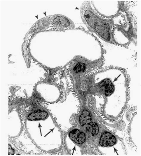 Transmission Electron Micrograph Of Glornerular Capillary Loops The