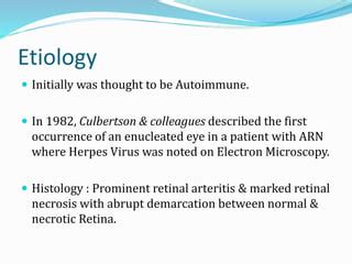 Acute Retinal Necrosis Ppt