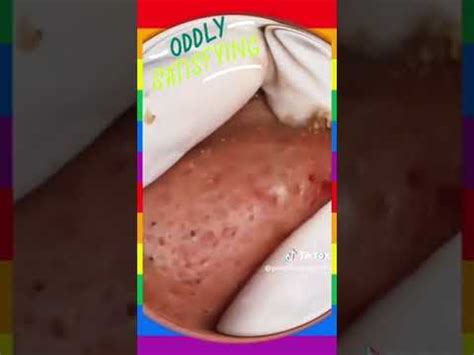 Cravos Espinhas Acne Escreva Se No Canal Para Mais V Deos Spar