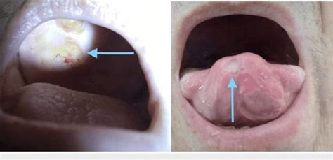 Mouth ulcers on the tongue and the roof of the mouth. | Download ...