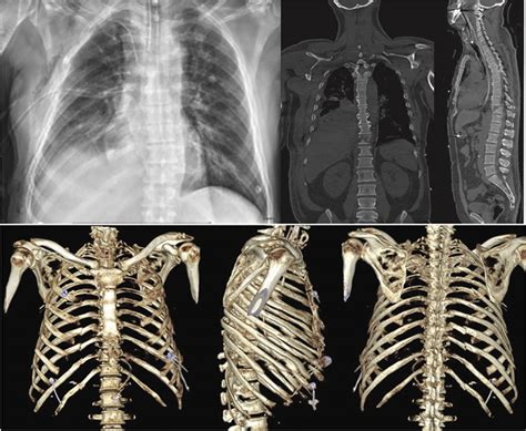 Rib Fracture Fixation With Osteosynthesis Plates In Bangkok Hospital