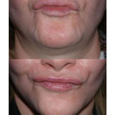 Botox Lower Face Rejuvenation Snatch And Glow London