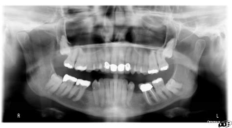 Maxillary Sinusitis Sinusitis Maxillary