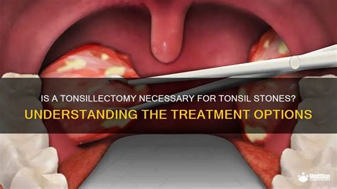 Is A Tonsillectomy Necessary For Tonsil Stones Understanding The