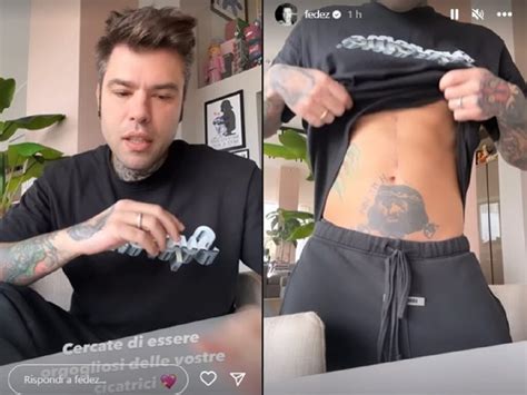 Fedez Mostra La Cicatrice Ai Fan Dopo Alcuni Mesi Dall Operazione