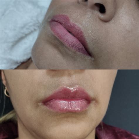 Preenchimento Labial Dr Igor Ramos