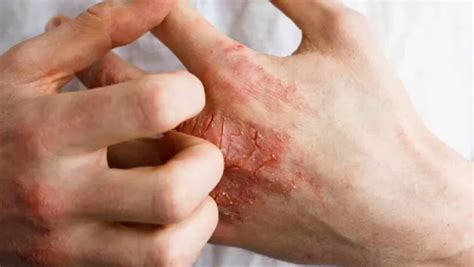 Mengenal Lebih Dekat Tentang Psoriasis Gejala Dan Penyebabnya Begini