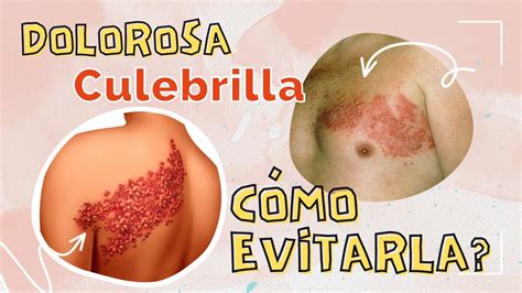 C Mo Tratar La Culebrilla O Herpes Zoster Y C Mo Evitar El Dolor