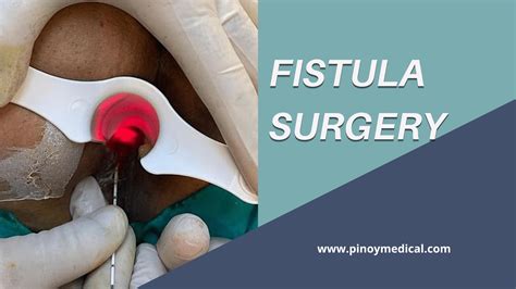 Fistula Surgery Price in the Philippines 2025 — PinoyMedical