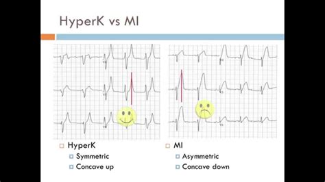 Killer Ekgs Youtube