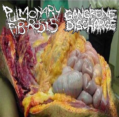 First Look At Split Pulmonary Fibrosisgangrene Discharge Good Guys