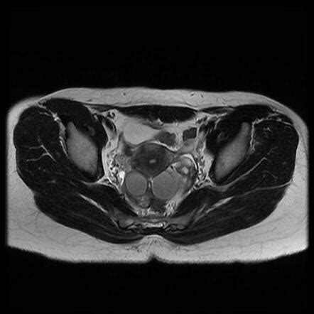 Ovarian Endometriomas Bilateral Image Radiopaedia Org