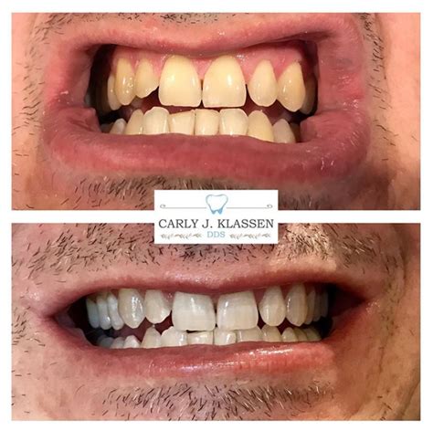 Tooth Whitening System Carly J Klassen DDS