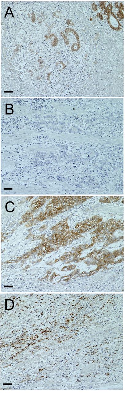 Sustained Aberrant Localization Of Kl 6 Mucin And β Catenin At The