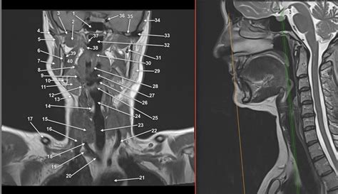 Ae Coronal Mri 2 Final Diagram Quizlet