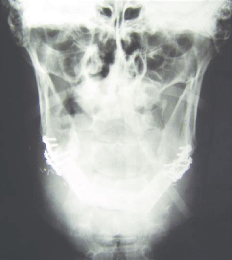 Free fibula after fixation in defect. Fig. 3. Frontal image of skull... | Download Scientific ...