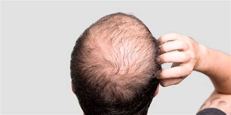 Conoces Las Causas De La Alopecia Desc Brela Aqu