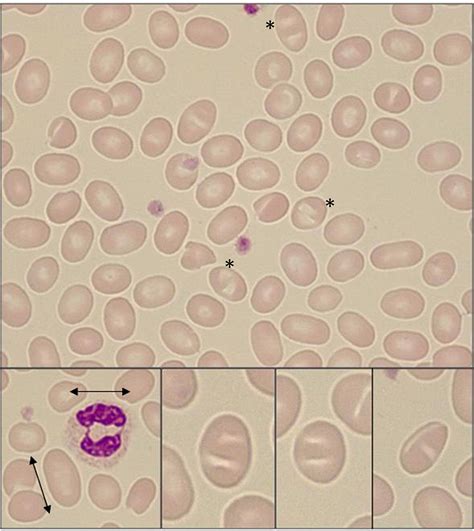 Southeast Asian Ovalocytosis Detected In A Critical Patient With Covid