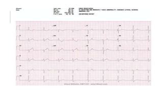 Sinus Node Dysfunction PPT