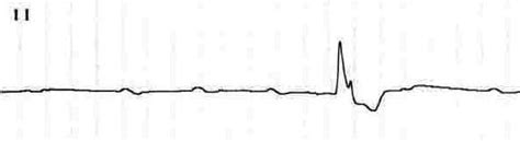 Killer Ecg Patterns • Litfl Medical Blog • Ecg Library