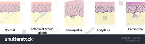 Morphology Cervix Pathology Under Microscope Illustration Stock Vector