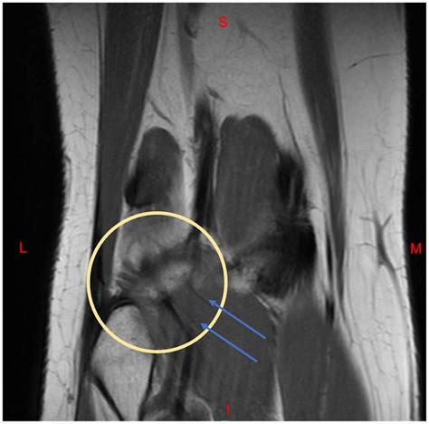 Coronal MRI of the right knee. The distal popliteal muscle is ...