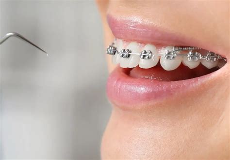 Can Braces Push A Long Tooth Further Into The Gums Exploring The Relationship Between Braces