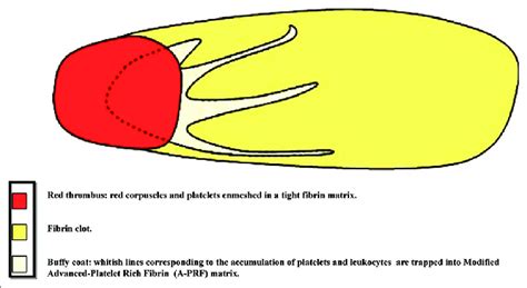 Schematic Description Of Modified Advanced Platelet Rich Fibrin Clot