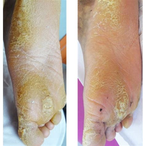 Evolution Of Plantar Keratoderma In Patient A Skin Lesions In