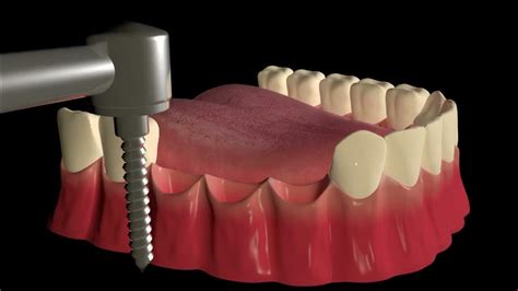 Implant Supported Dental Bridge Youtube