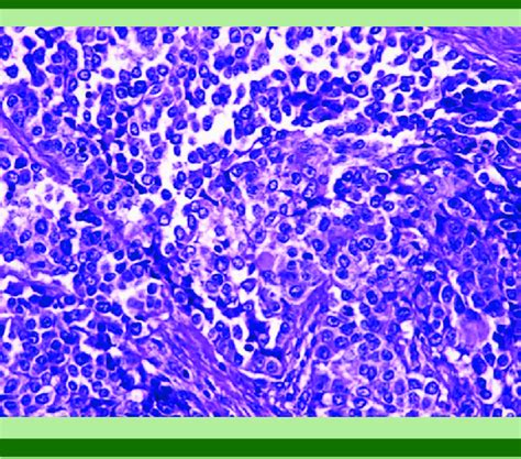 Carcinoma indiferenciado Mantos sólidos de células poco cohesivas