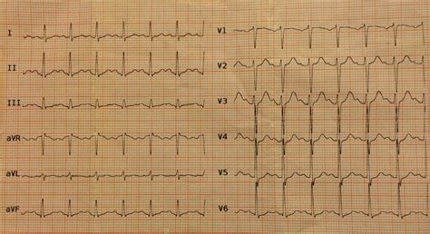 Twelve Lead Electrocardiogram Revealed Sinus Tachycardia Download