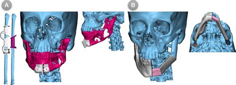 A 3D Designs Of Mandibular And Fibular Cutting Guides B Virtual