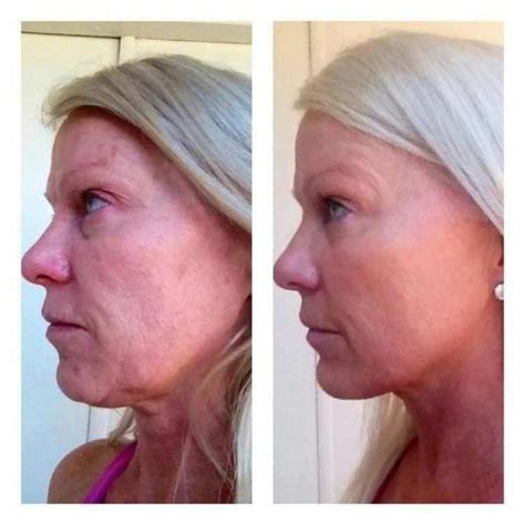 Nerium Before And After Picture Anazoe Derma Spa And Tanning