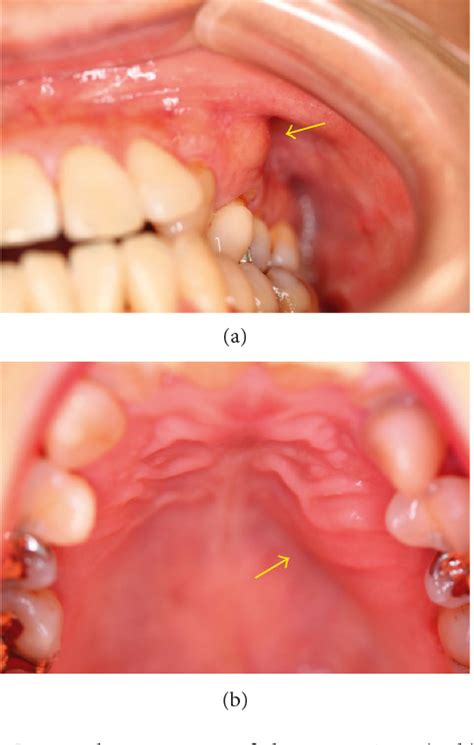 Figure 1 From Initial Stage Primary Intraosseous Squamous Cell