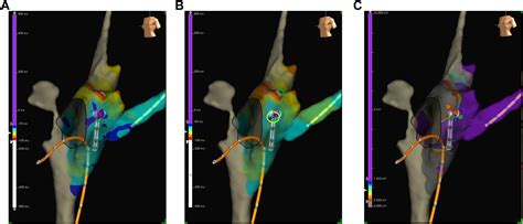 Combination of slow pathway late activation maps and voltage gradient ...